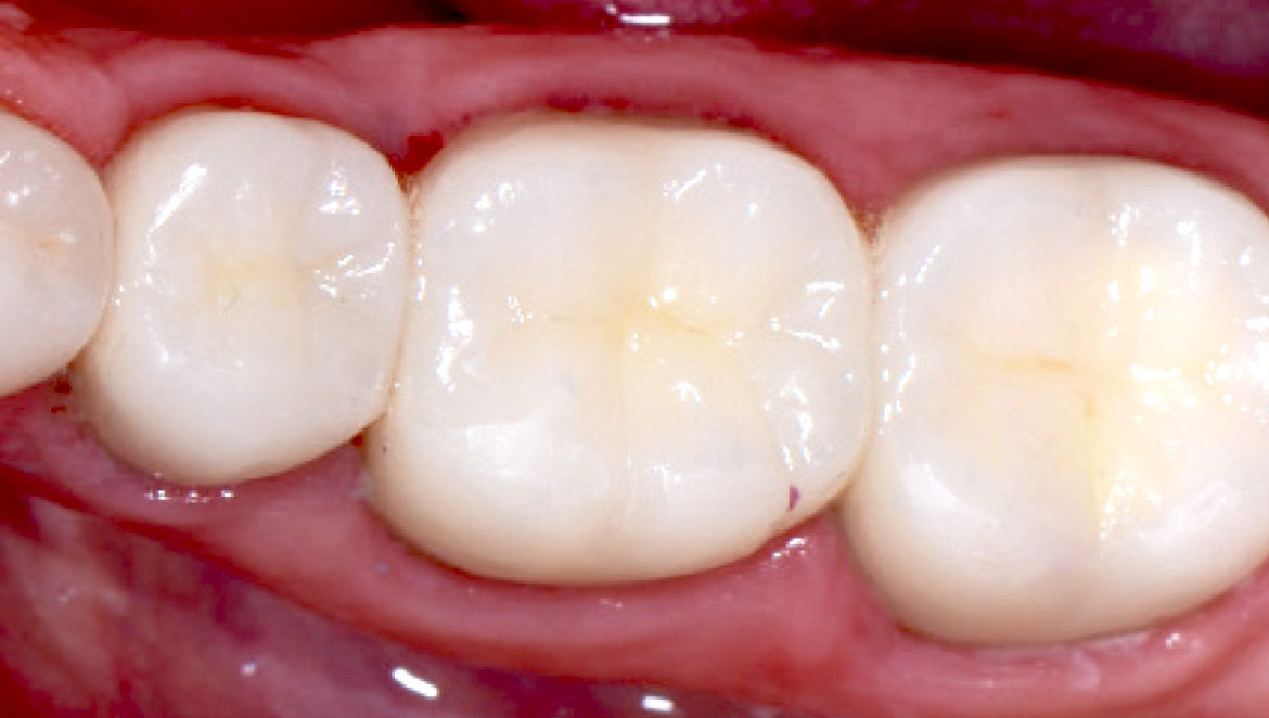 What you should know about Composite Fillings